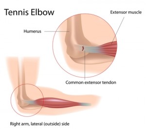 Illustration - Tennis Elbow