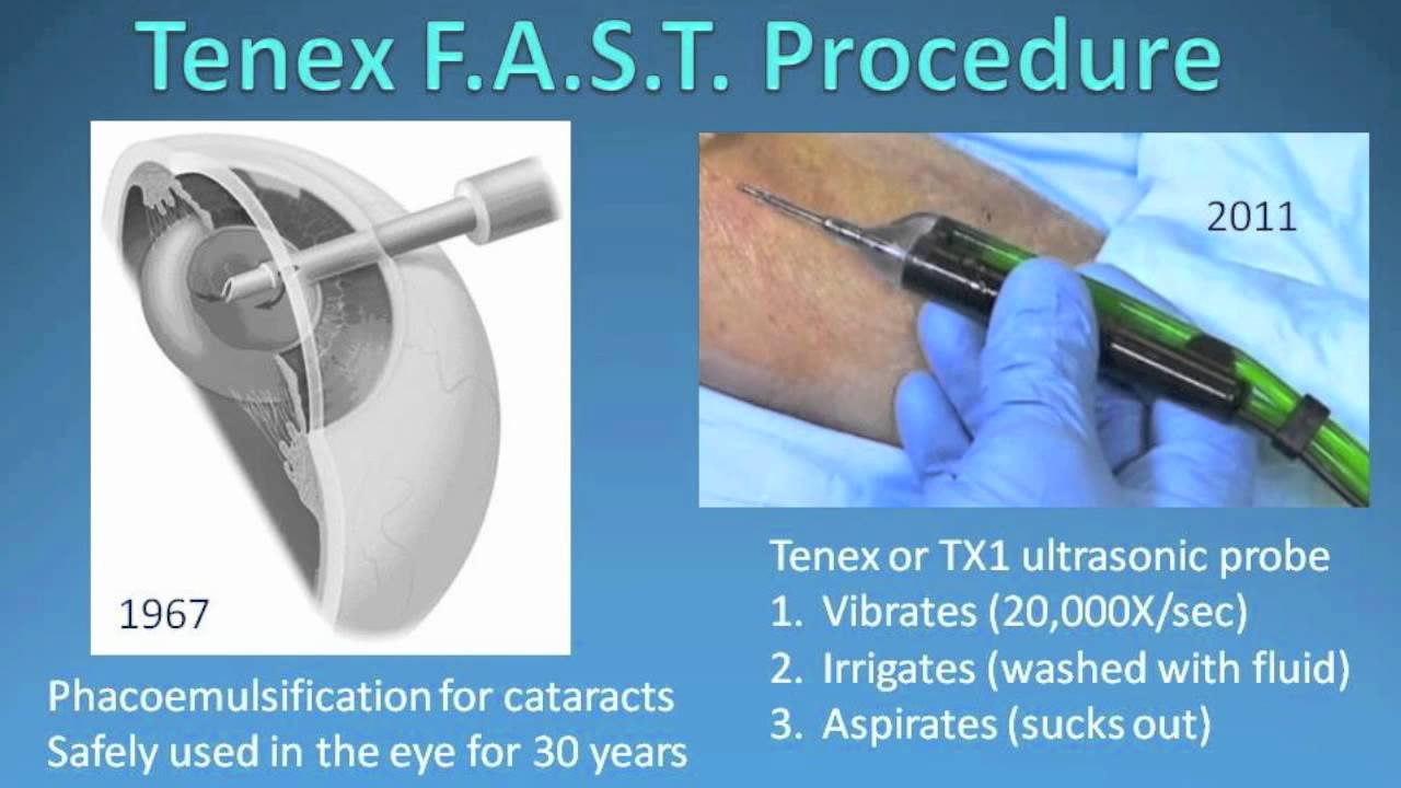Demo Of Less Invasive Fast Tennis Elbow Surgery Procedure 6919