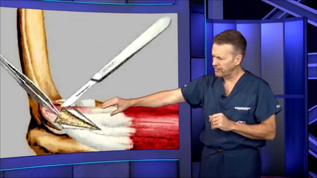 Thumbnail for video with a surgeon explaining surgery for Tennis Elbow