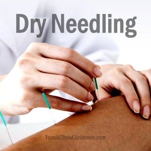 Trigger Point Dry Needling for treating Golfer's and Tennis Elbow