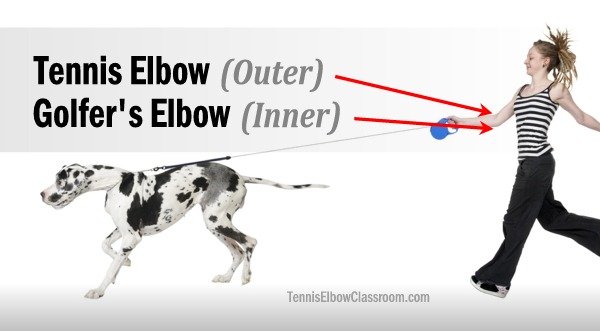 Dog walking related injuries can include Golfer's and Tennis Elbow